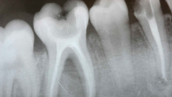 Radiologie dentara - Radiografii dentare